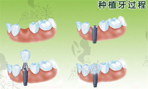 牙齿种植过程