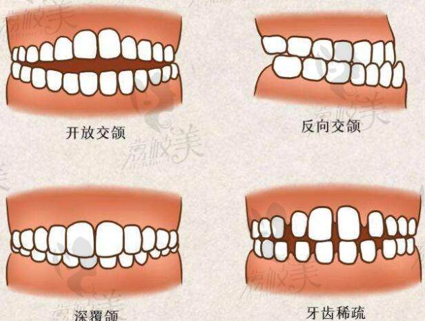 各种错颌畸形的类型