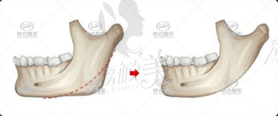 娇点整形下颌角手术