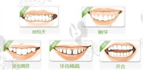 需要做牙齒矯正的類型