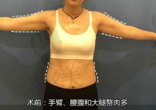 南京美贝尔整形医院吸脂术前