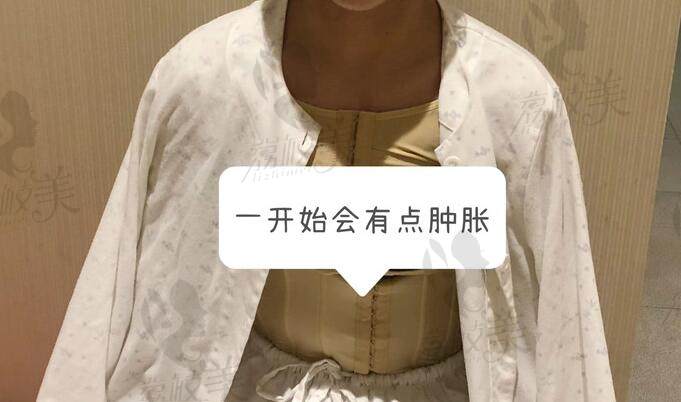 南京美贝尔吸脂恢复期