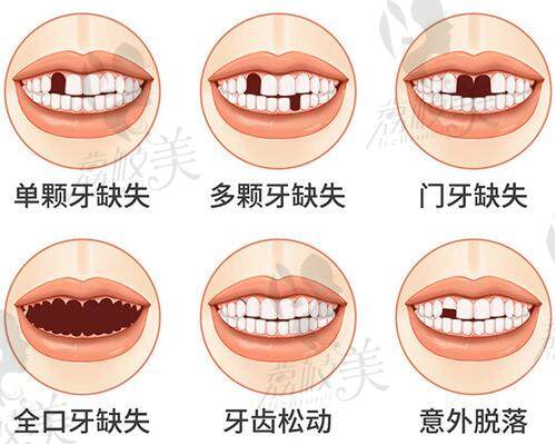 牙齒缺失情況