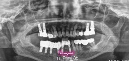 北京劲松口腔种植牙