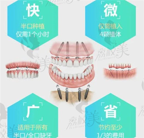 巴州美康口腔医院院长刘昆种植牙技术优势