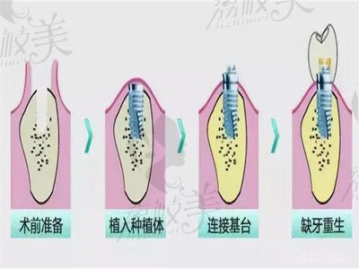 扬州金铂利口腔种植牙