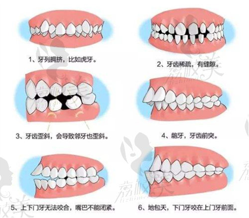 需要牙齒矯正的類型