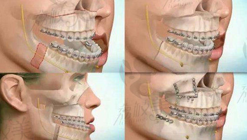 正颌手术原理过程