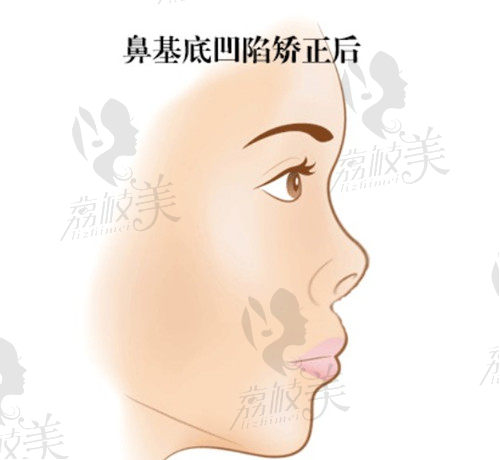 正颌手术可以改善鼻基底凹陷吗