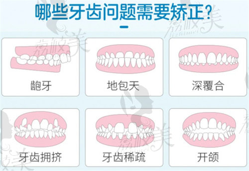 什么牙齿需要矫正