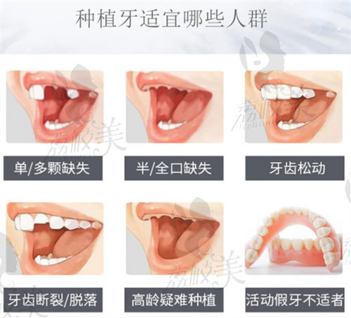 種牙適宜人群