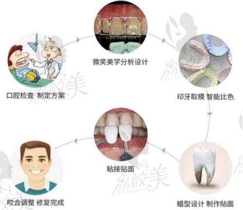 上海罗缘口腔瓷贴面流程