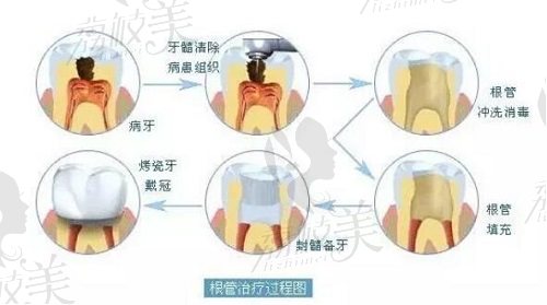 上海松豐口腔根管治療步驟