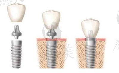 dentium登腾种植体的特点.jpg