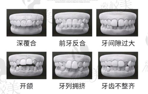 深圳民心李好于做牙齿矫正