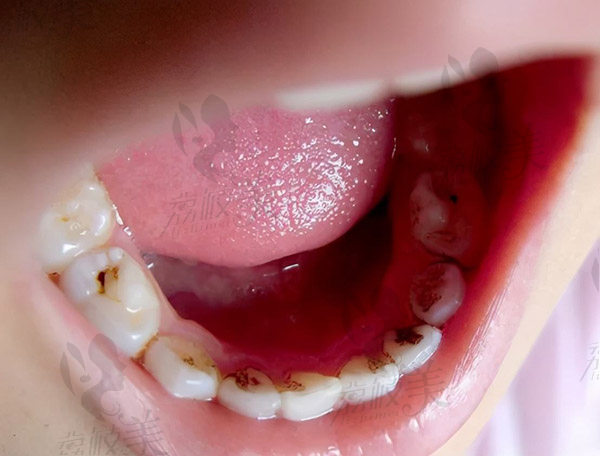 儿童牙齿龋齿