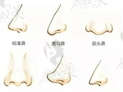 假体隆鼻可以维持一辈子吗？选择哪一种隆鼻方式更好？