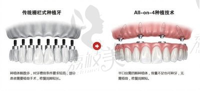 all-on-4種植技術(shù)優(yōu)勢