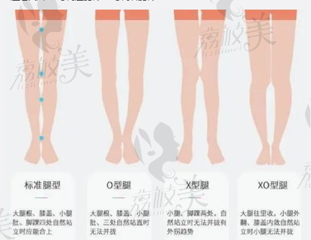 需要腿型矫正的情况