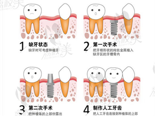 种植过程