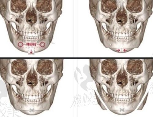 韩国尹昌云的下颌角手术方式