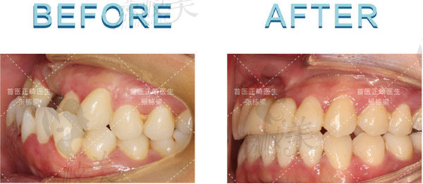 张栋梁医生正畸前后对比图