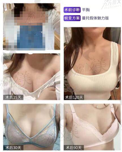 北京丽都医疗美容医院假体隆胸