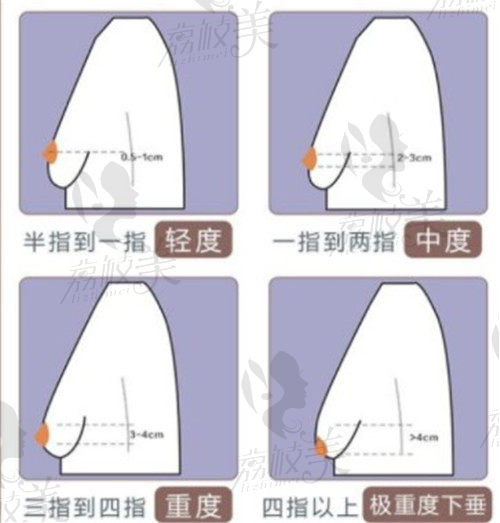 深圳南雅整形花苞提升术优势