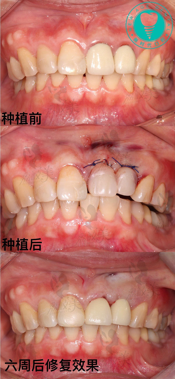 种植牙前后对比图