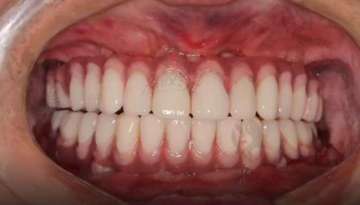 全口种植牙术后恢复图