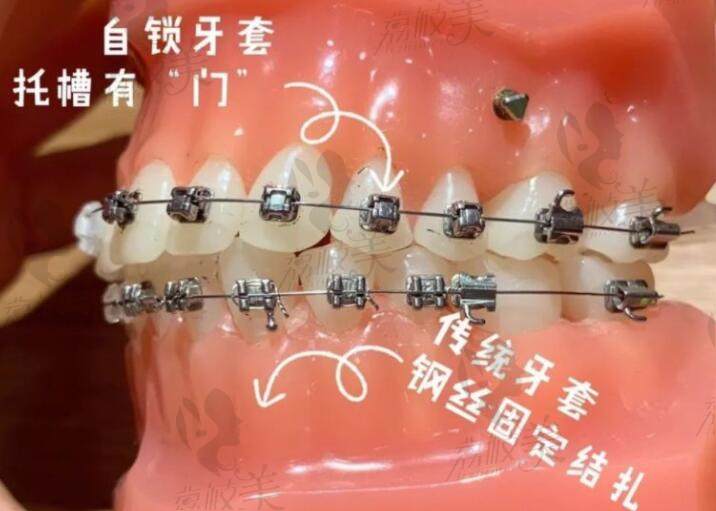 牙齿矫正自锁好传统牙套的区别