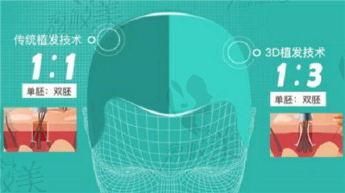 深圳新生3D植发技术优势