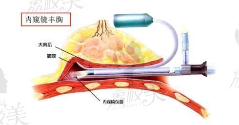 內(nèi)窺鏡隆胸示意圖