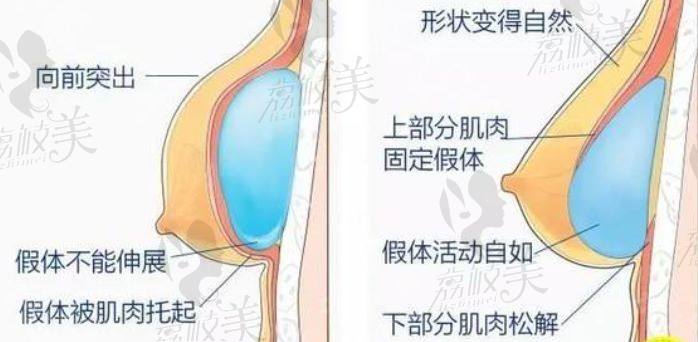 隆胸示意圖