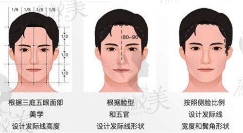 熙朵发际线种植审美