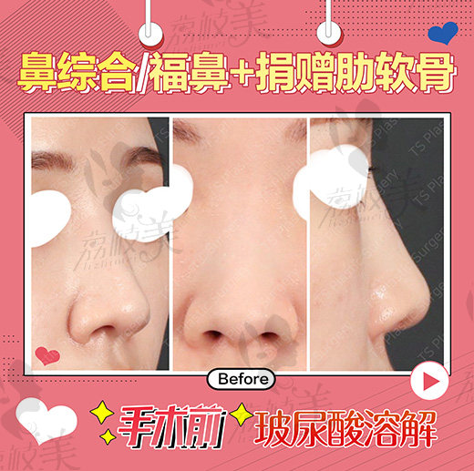 鼻综合术前