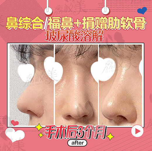 鼻综合术后3个月