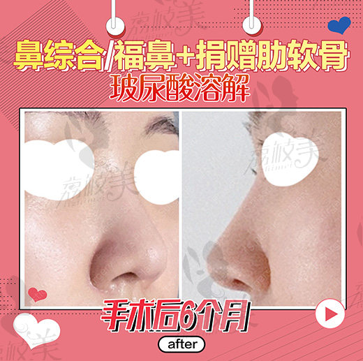 鼻综合术后6个月