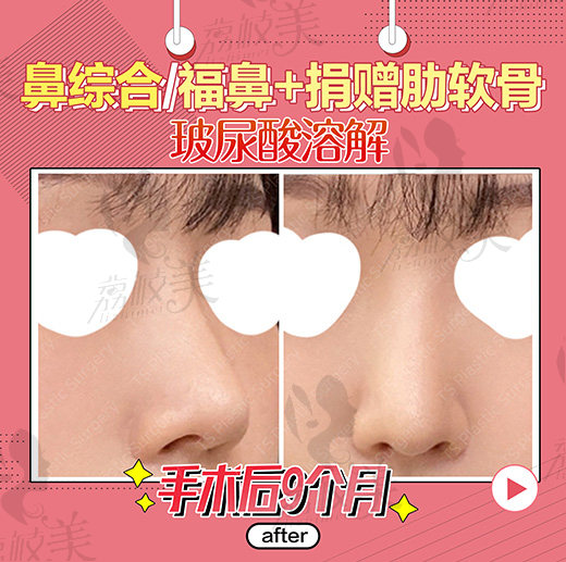 鼻综合术后9个月