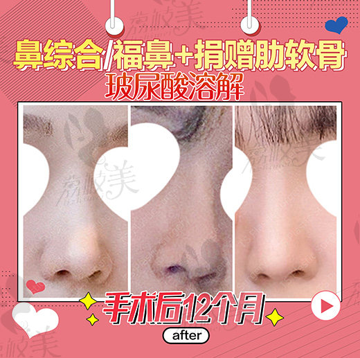 鼻综合术后1年