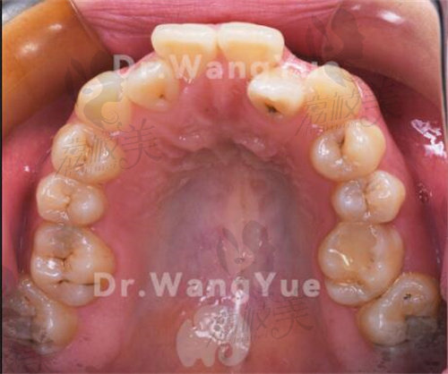 王月錯(cuò)頜牙列不齊矯正前