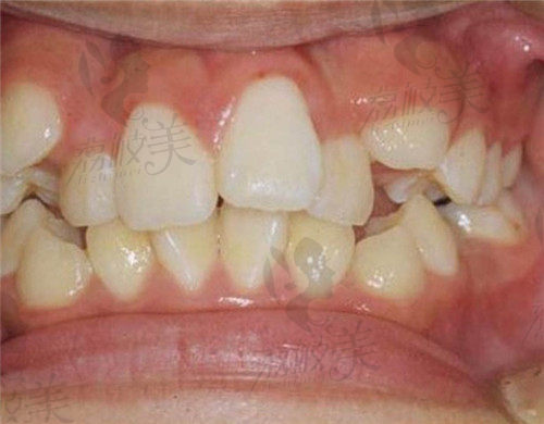 上海良宜口腔牙齿矫正术前范例