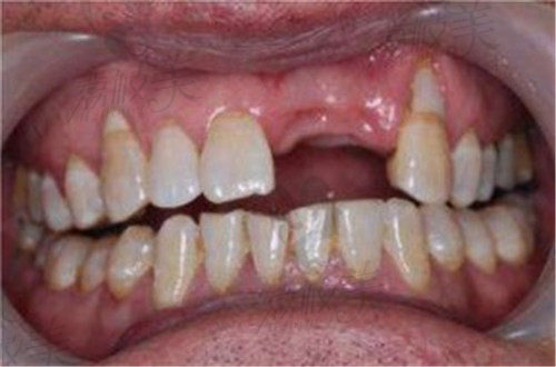 上海良宜口腔种植牙术前范例