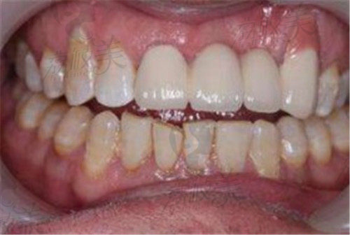 上海良宜口腔种植牙术后范例