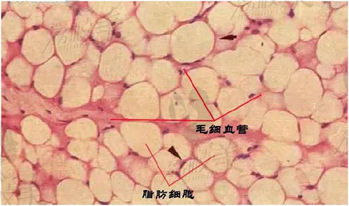 广州军美王世虎自体脂肪填充技术