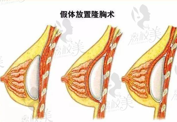 双平面丰胸