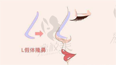 周创业医生隆鼻的技术优势1.jpg