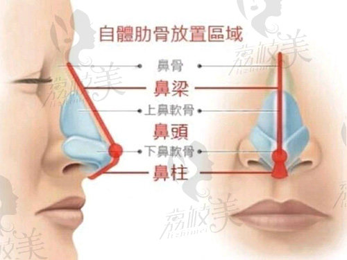肋骨隆鼻放置区域