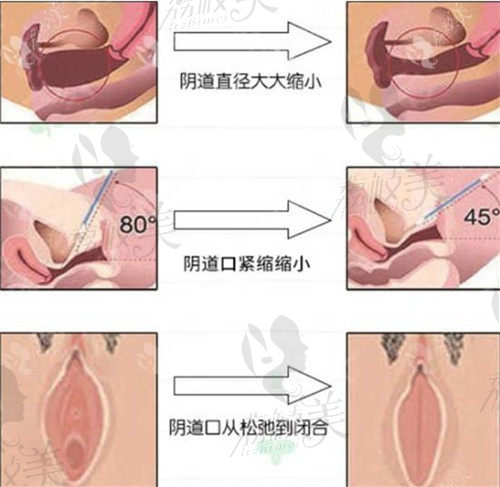 3D生物束带阴道紧缩术作用