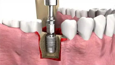种植牙手术前的注意事项5.jpg